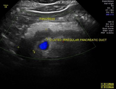 rasshiren-protok-pankreas1