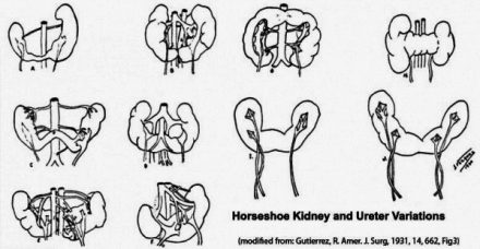Horseshoe_kidney