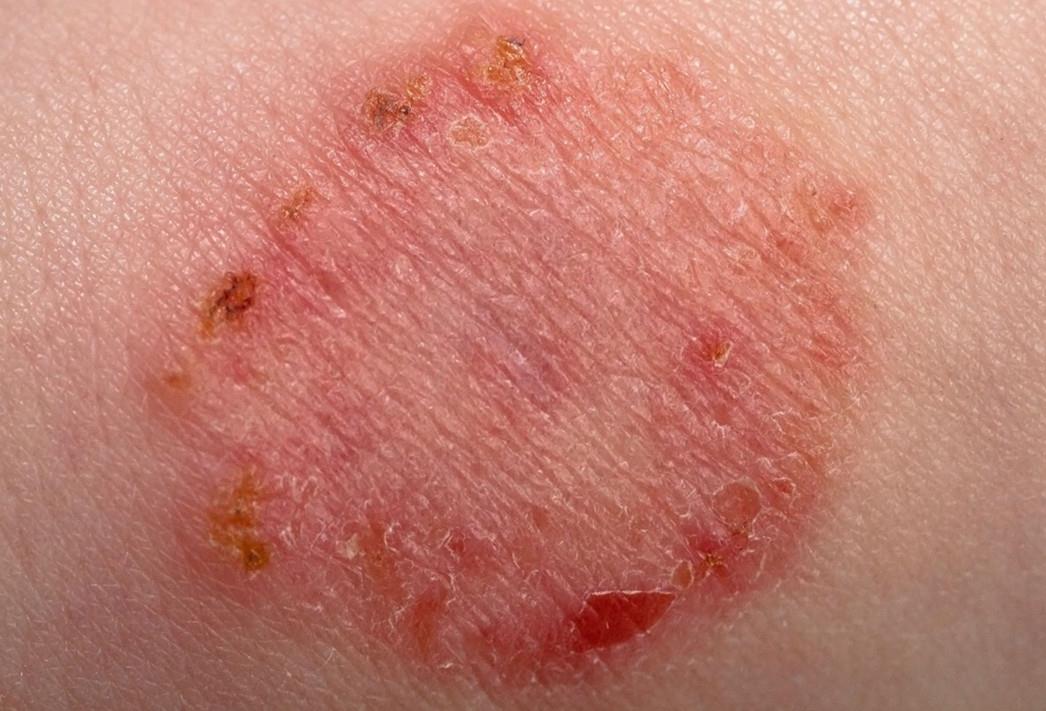 Инфицирование кожи при атопическом дерматите thumbnail