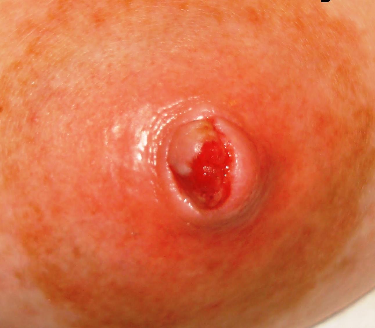 воспаление сосков груди у женщин фото 99