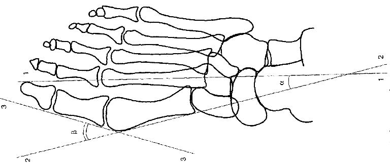 Угол стопы. Поперечное плоскостопие схема рентген. Поперечное плоскостопие на рентгенограмме. Поперечное плоскостопие рентген. Поперечное плоскостопие рентген измерение.