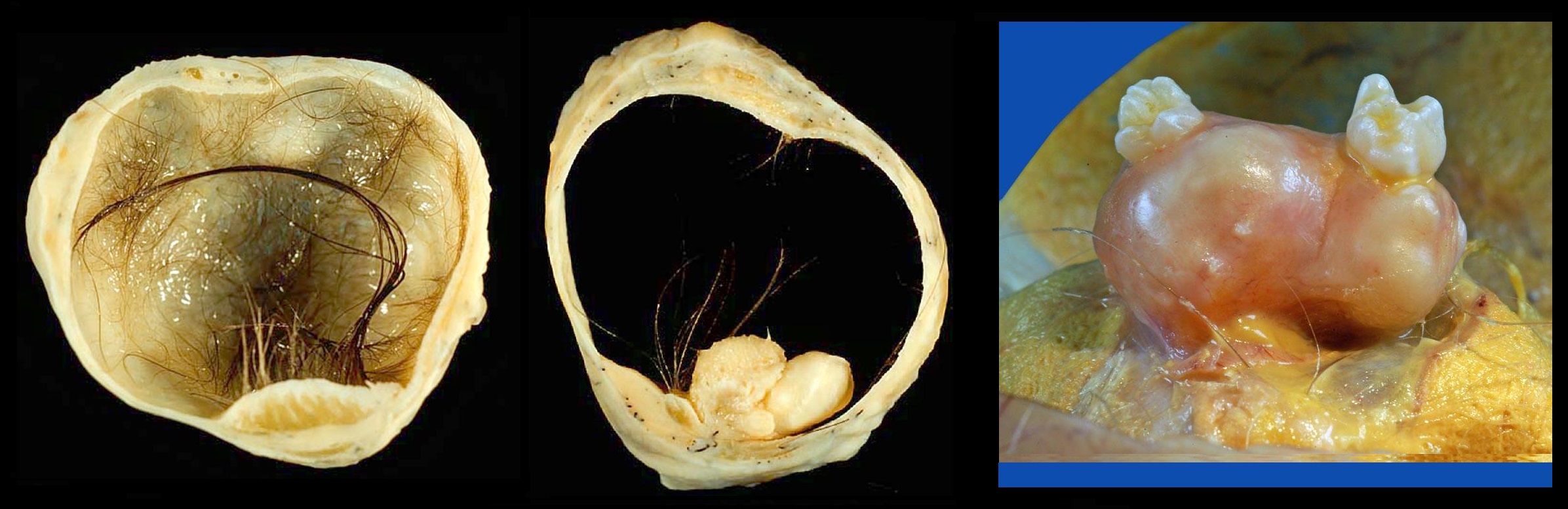 Эндометриоз киста яичника фото узи thumbnail