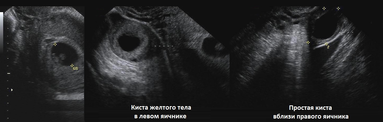Ультразвуковая картина кисты яичников thumbnail