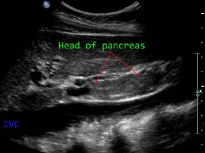 pancreas-ls-norm
