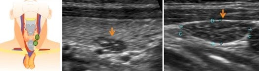 Эктопия железы. Паращитовидные железы на УЗИ. Щитовидная железа паращитовидные железы тимус. Эктопия щитовидной железы. Паращитовидная железа у детей на УЗИ.