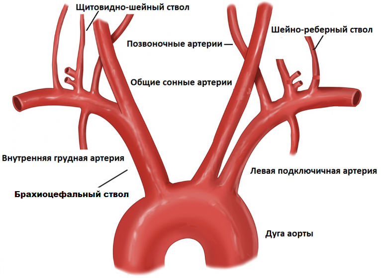 Бца анатомия сосуды. Атеросклероз сосудов брахиоцефальных артерий. Сосуды брахиоцефального ствола. Сонная артерия брахиоцефальный ствол.
