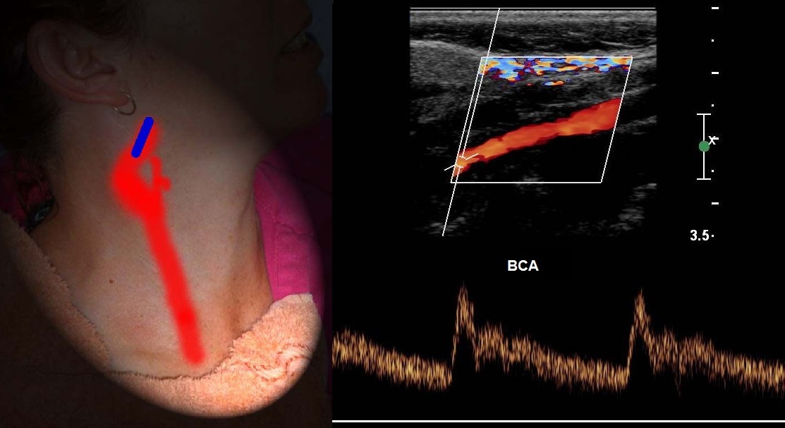 Доплер артерий. Ультразвуковое триплексное сканирование сосудов дуги аорты. УЗДГ – ультразвуковая допплерография сосудов. Стеноз сонной артерии УЗДГ. Допплеровское сканирование сосудов шеи.