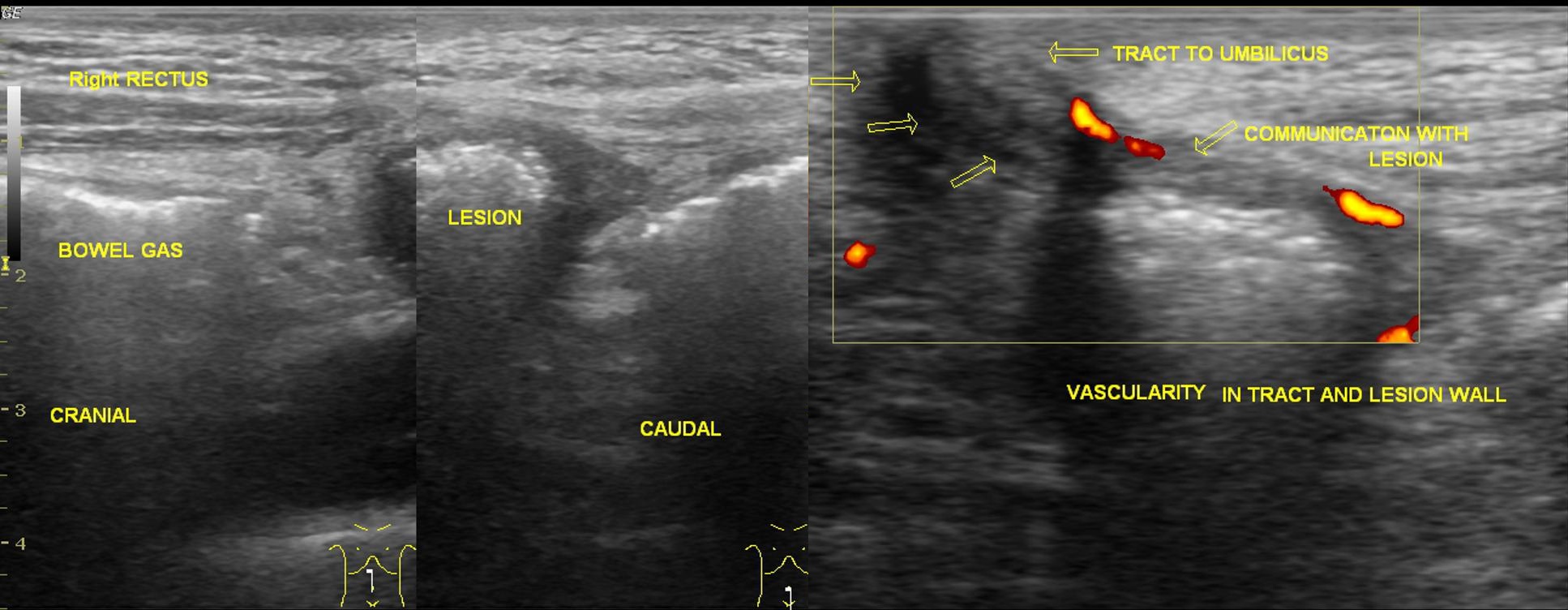 Cumulus oophorus on ultrasound