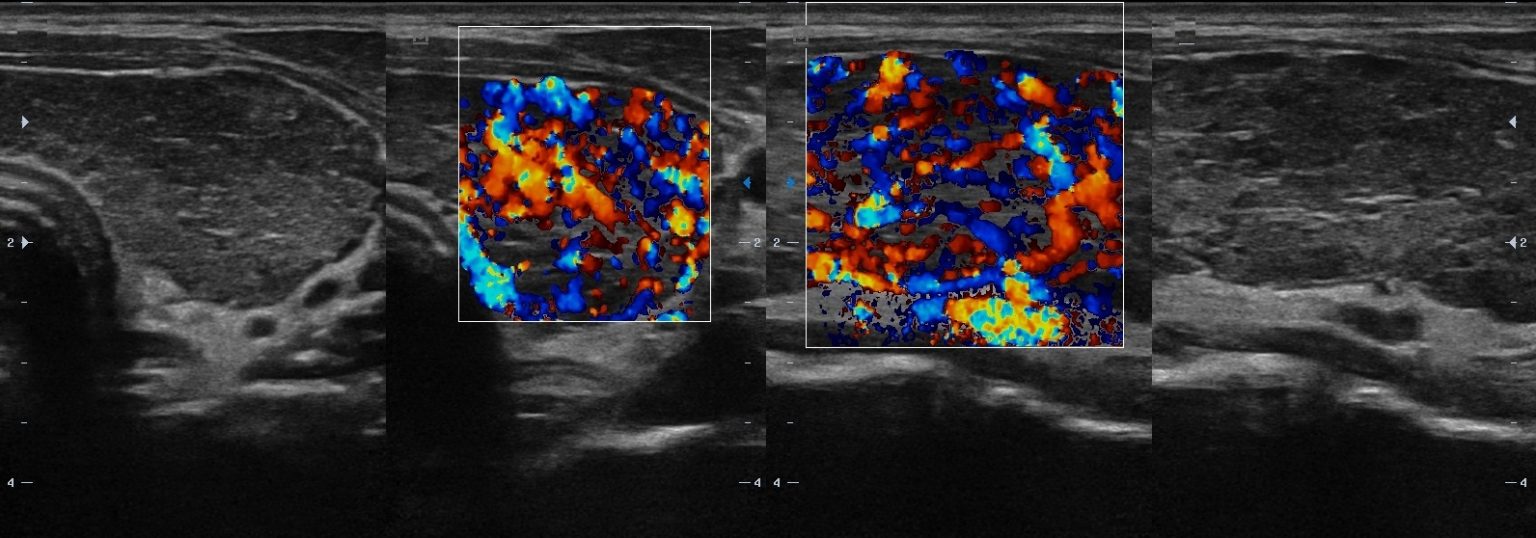 Уз картина диффузных изменений паренхимы щитовидной железы