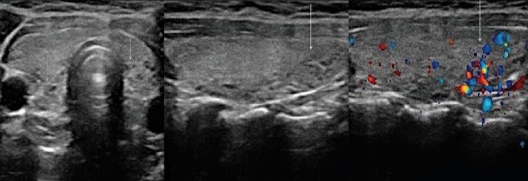 Узи картина тиреоидита
