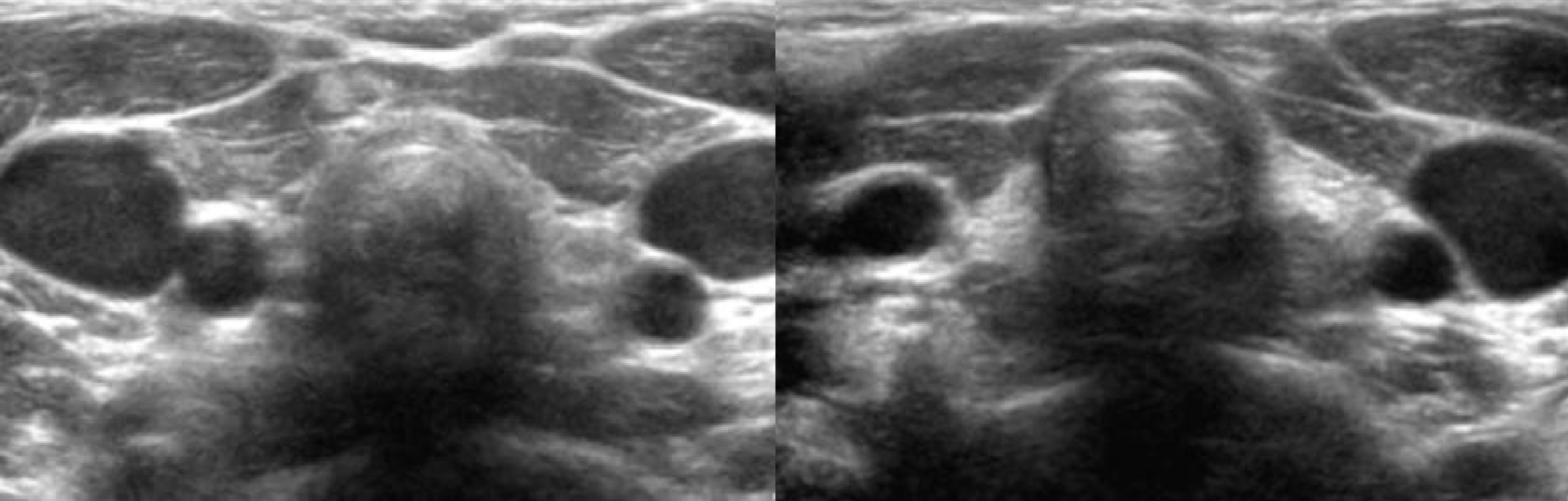 Аплазия щитовидной железы на УЗИ