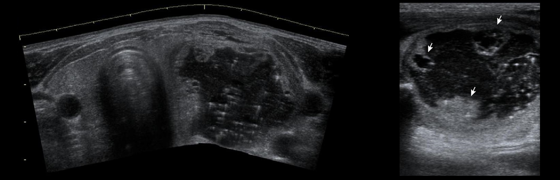Фото узи щитовидной железы с узлом