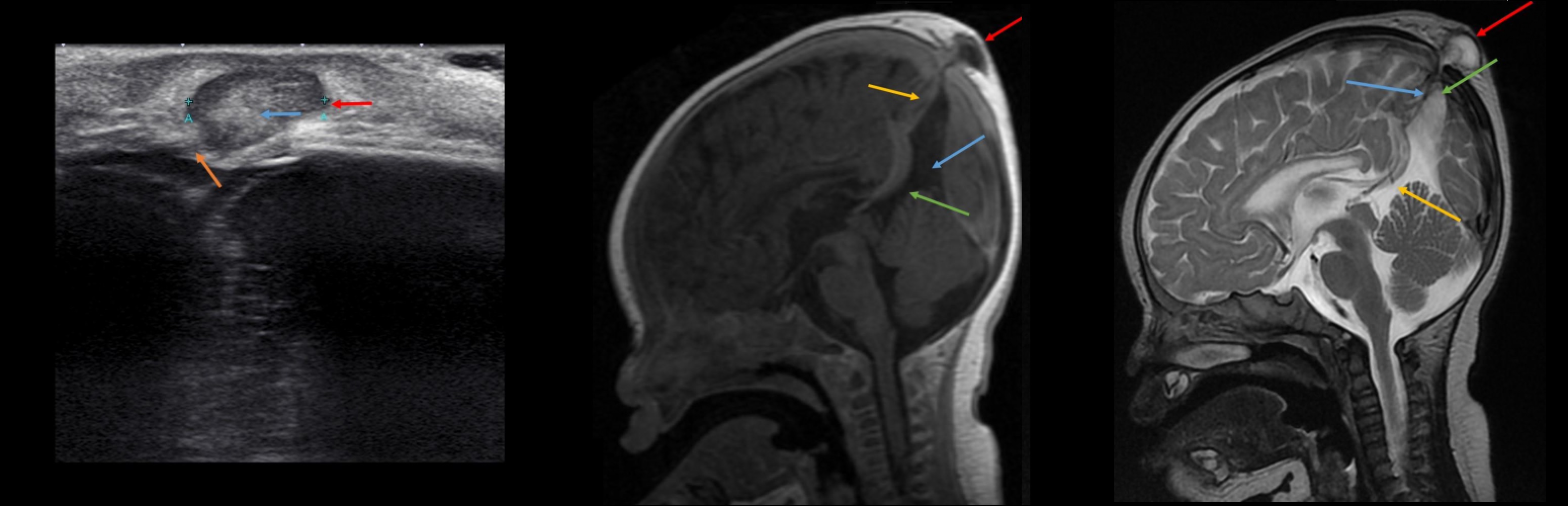 Гематома головного мозга - симптомы и лечение