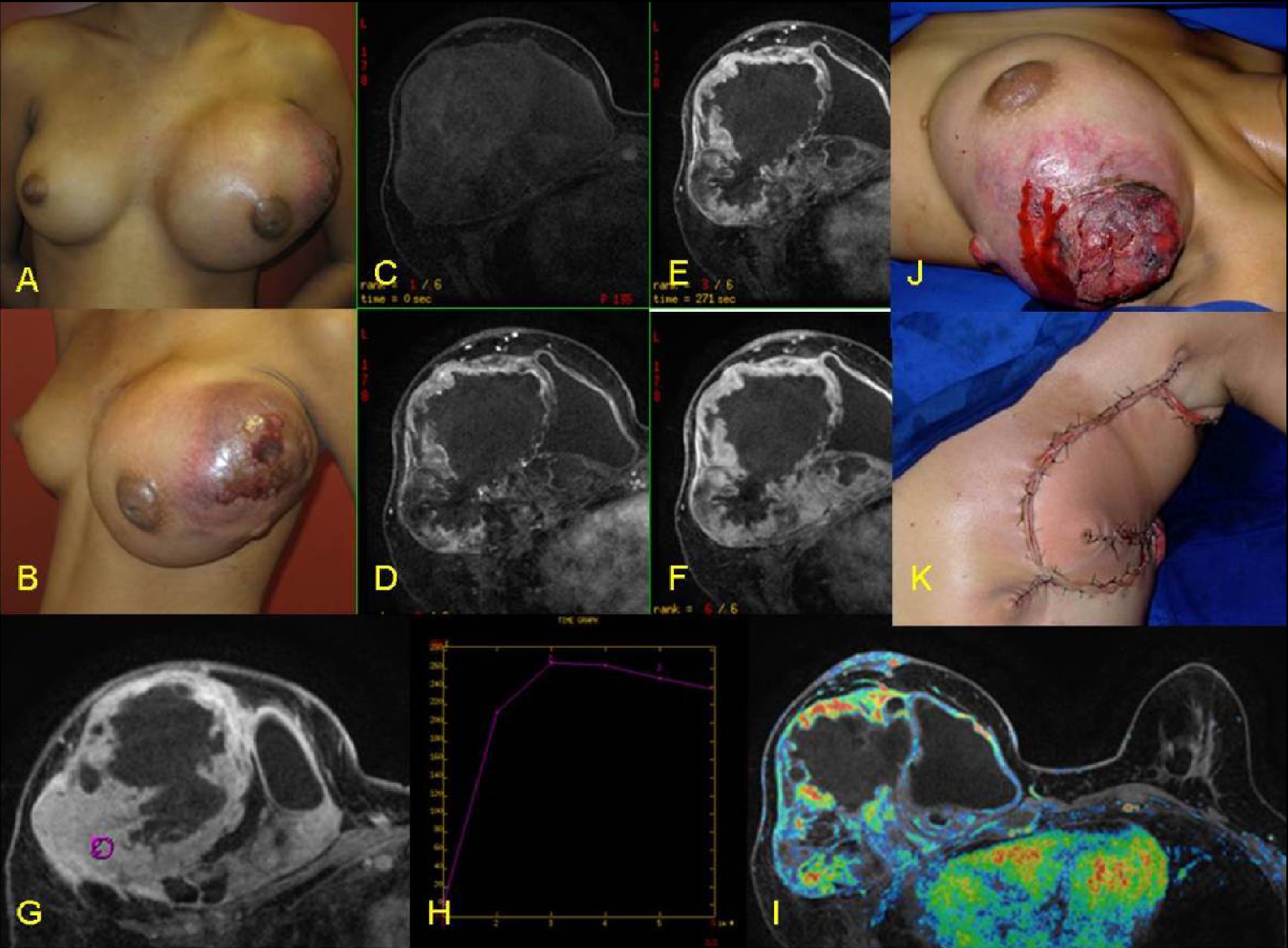 злокачественная опухоль в груди у женщин фото 12