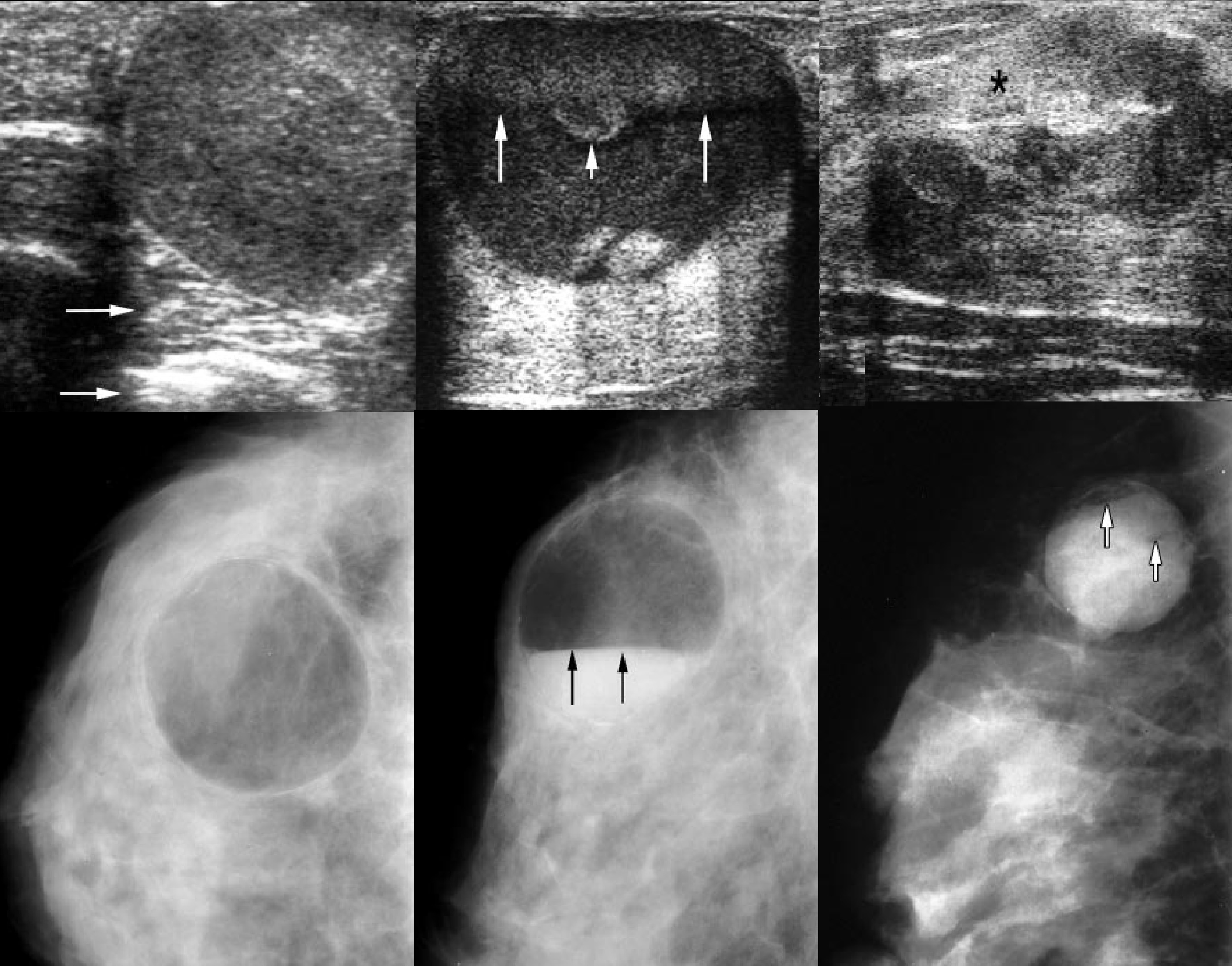 фиброаденома молочной железы маммография фото