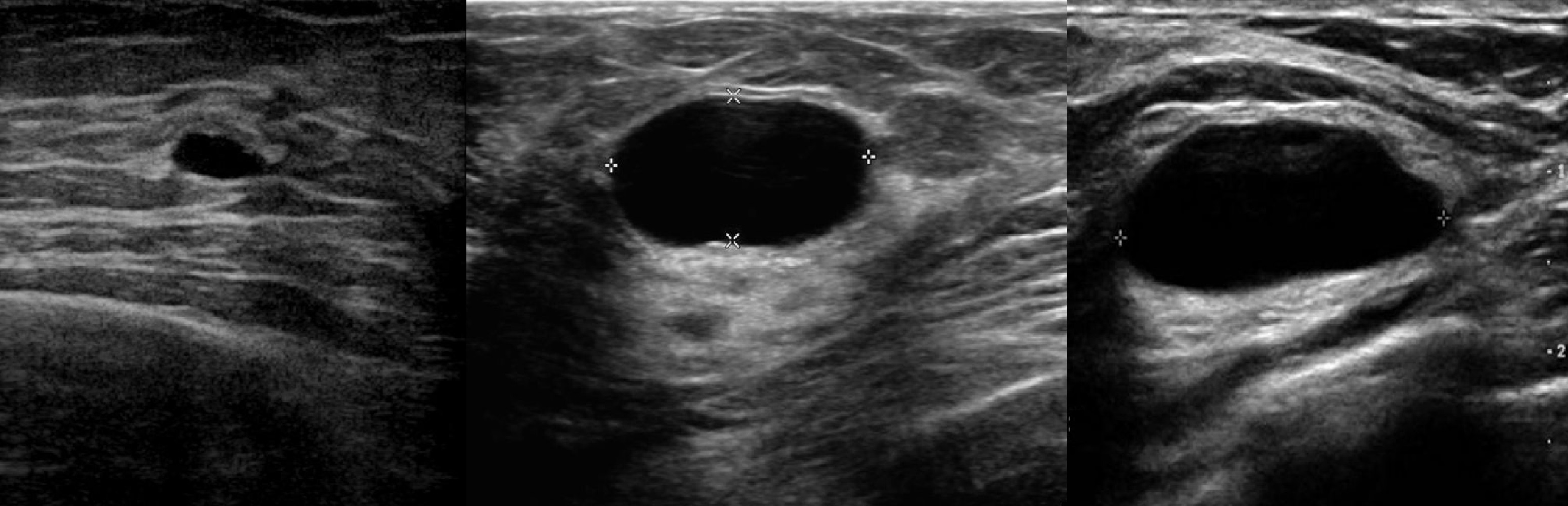 фиброаденома в груди во время беременности фото 91
