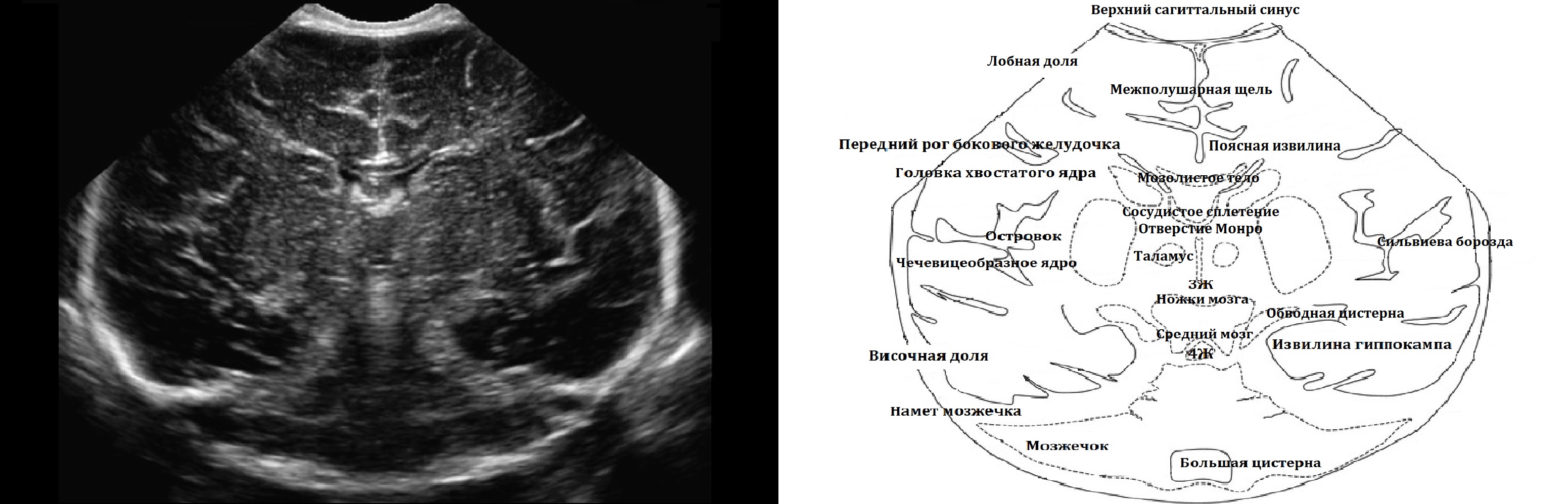 Расширение желудочков у новорожденного. Нейросонография 4 желудочек. Боковые желудочки головного мозга на УЗИ. Анатомия головного мозга плода на УЗИ. УЗИ анатомия головного мозга новорожденных нейросонография.