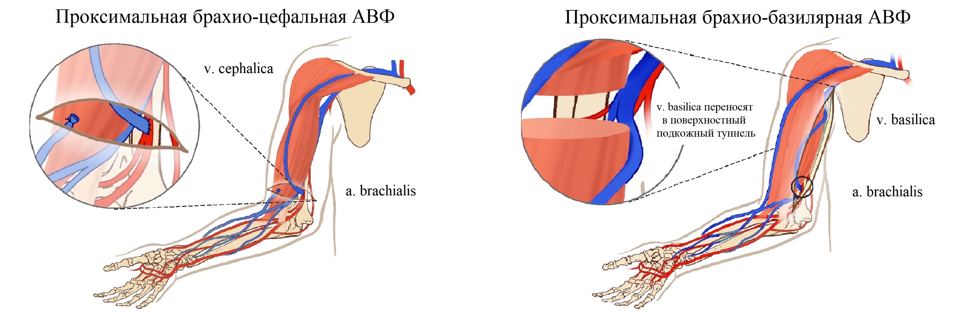 Артериовенозный шунт. Артерио-венозная фистула для гемодиализа. Фистула гемодиализ схема. Артерия венозная фистула.