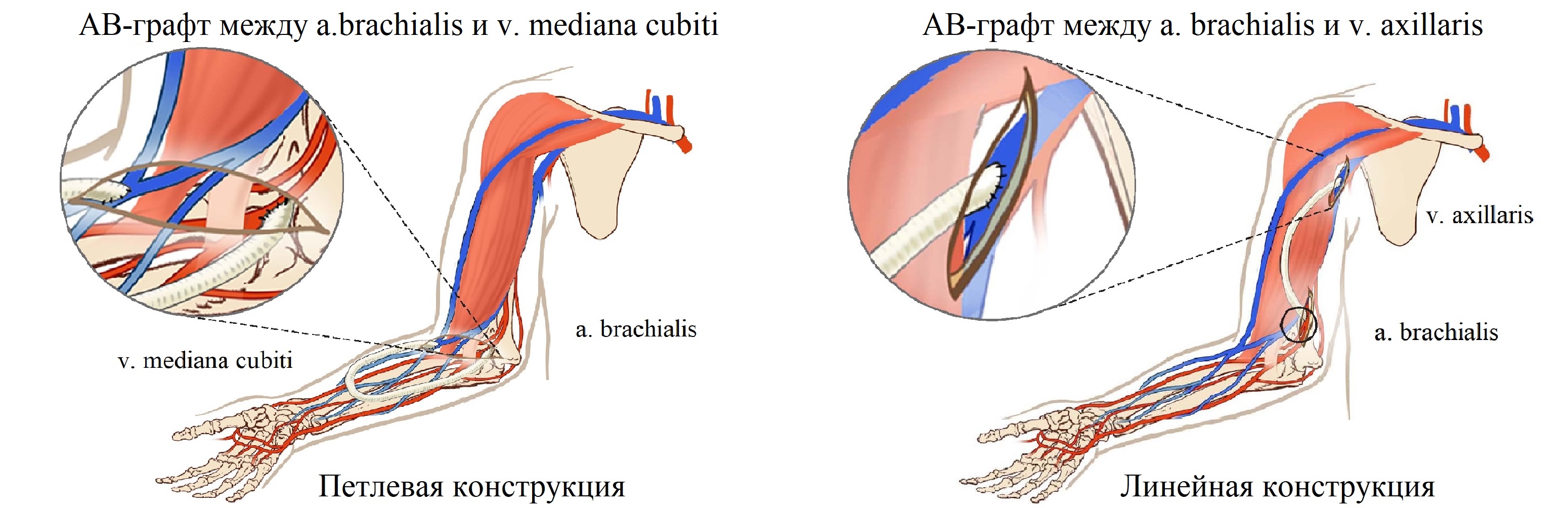 Артериовенозный шунт. Артерия венозная фистула. Протез фистулы для гемодиализа. Артерио-венозная фистула для гемодиализа.