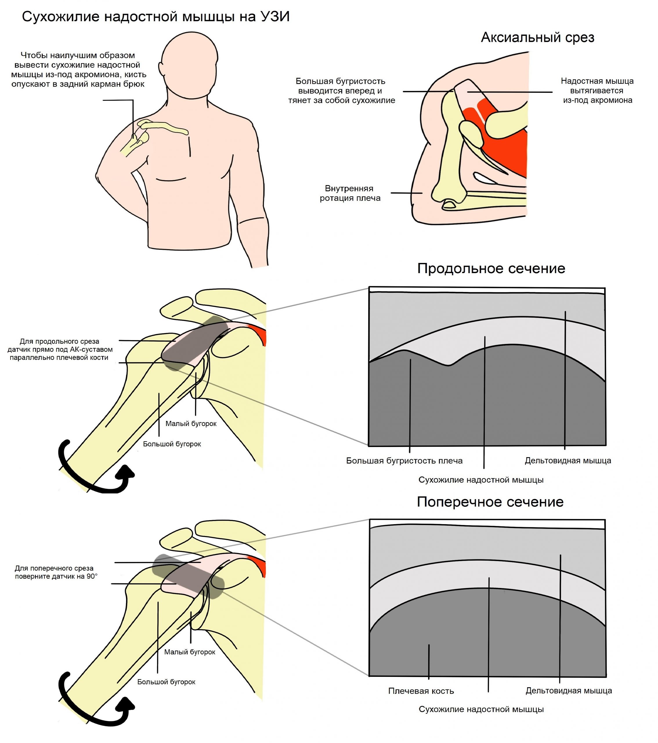 Разрыв надостного сухожилия плечевого сустава лечение. Повреждение надостной мышцы плечевого сустава. УЗИ надостной мышцы плеча. Сухожилия надостной мышцы плечевого сустава. Артроскопический шов надостной мышцы.